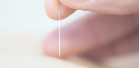 Akupunktur, Praxis für Orthopädie von Dr. Kai Horstschäfer